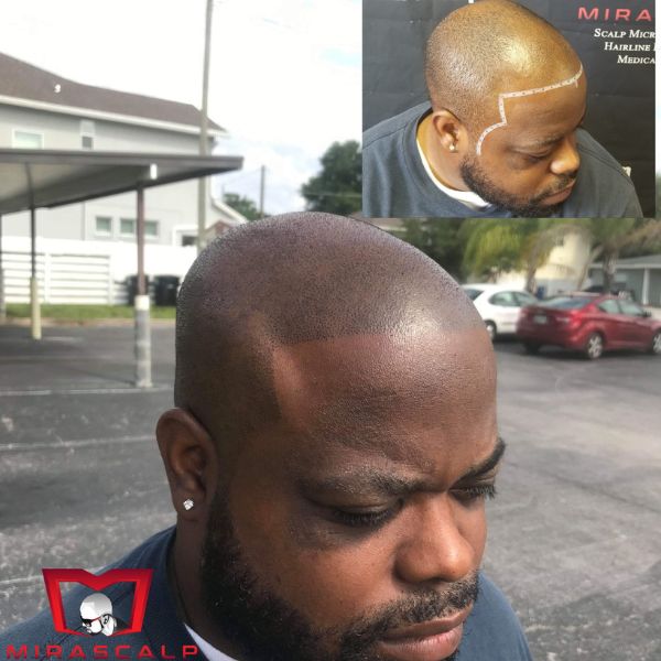 Scalp Micropigmentation