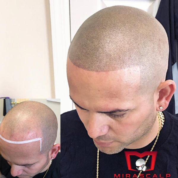 Scalp Micropigmentation