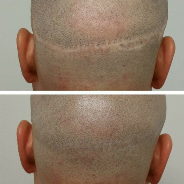 Scar Cover Ups Side 1