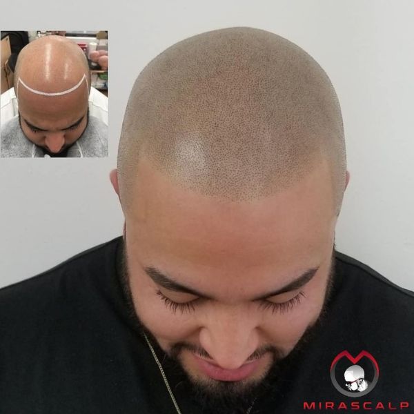 scalp micropigmentation