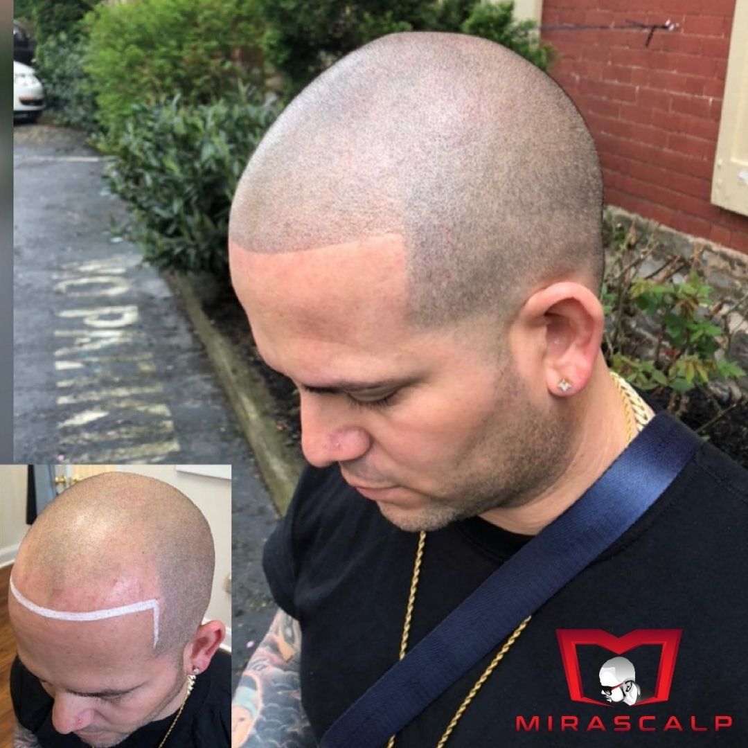 smp before and after picture