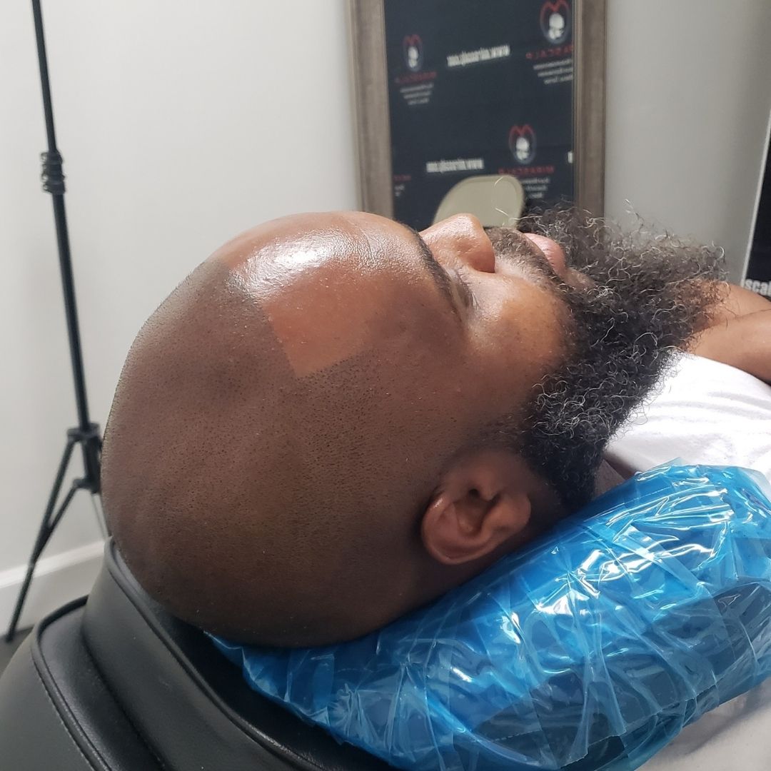 scalp micropigmentation treatment