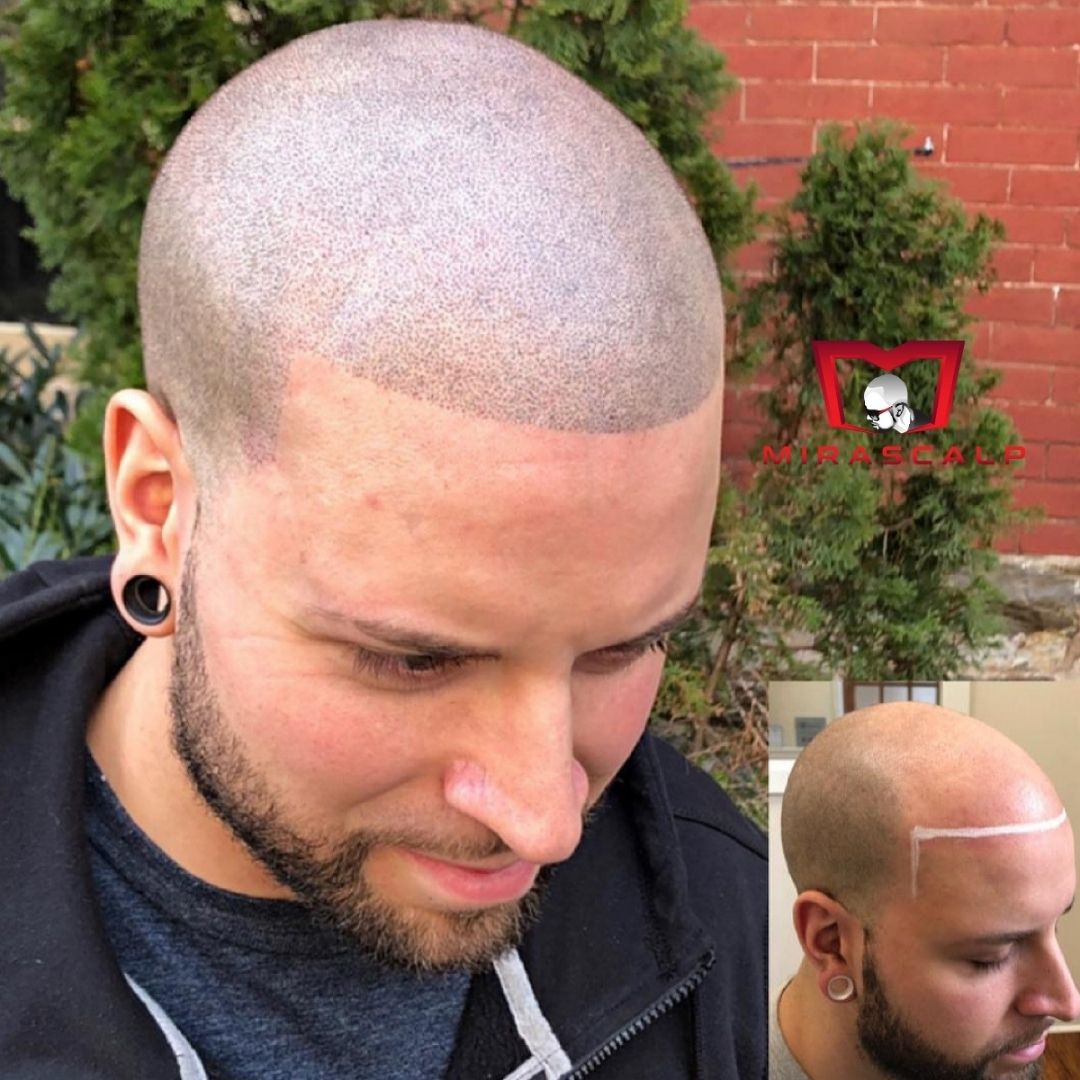 SMP before and after