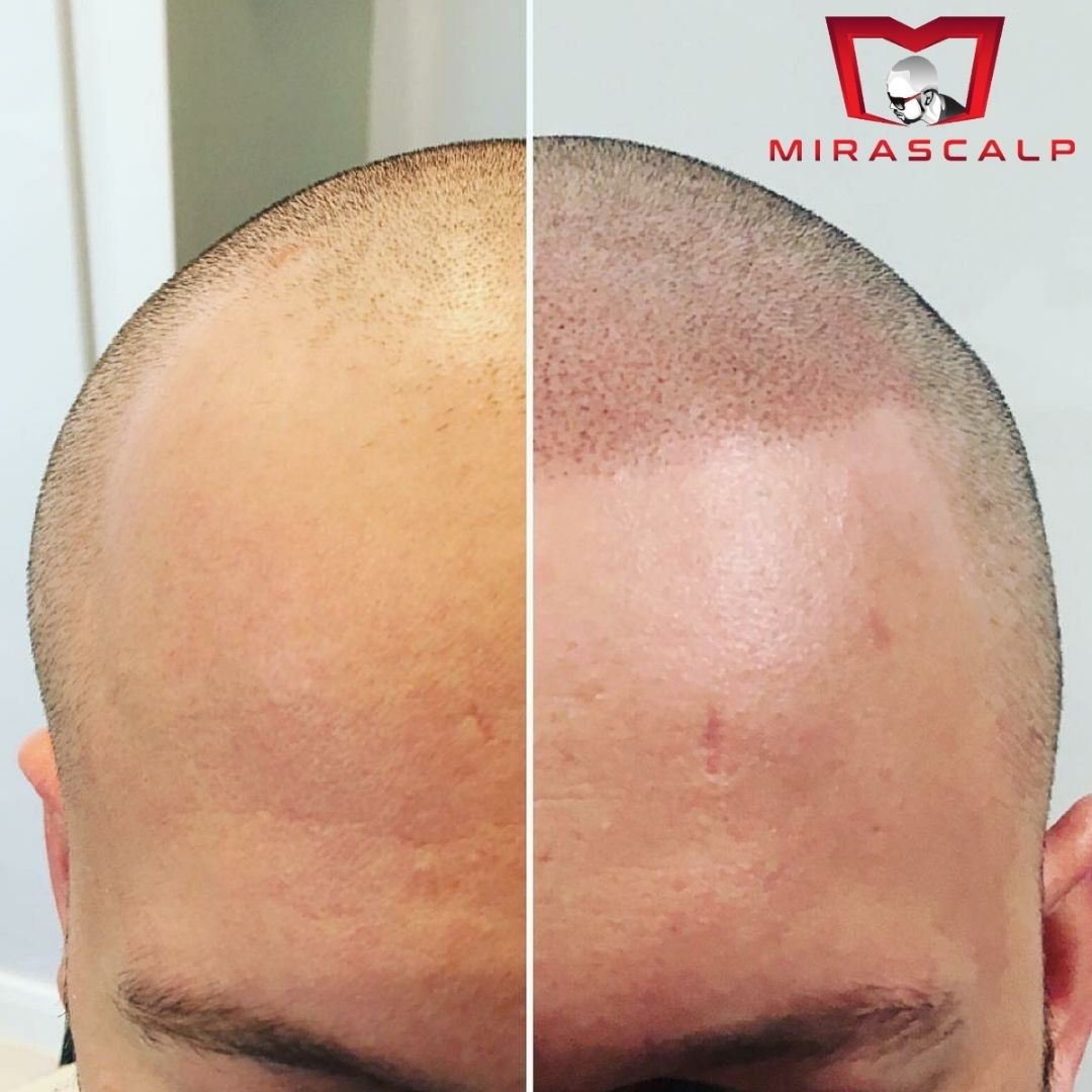 smp before and after comparison