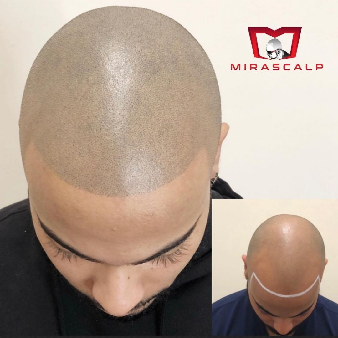 smp before and after