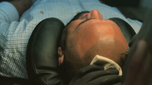 scalp micropigmantation